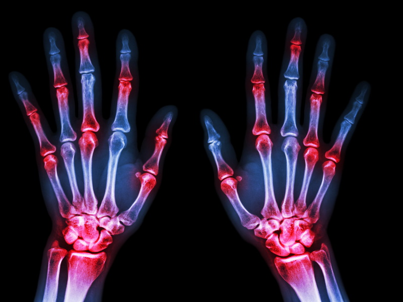 Collagen Induced Arthritis: an Experimental Model for Rheumatoid Arthritis (RA)